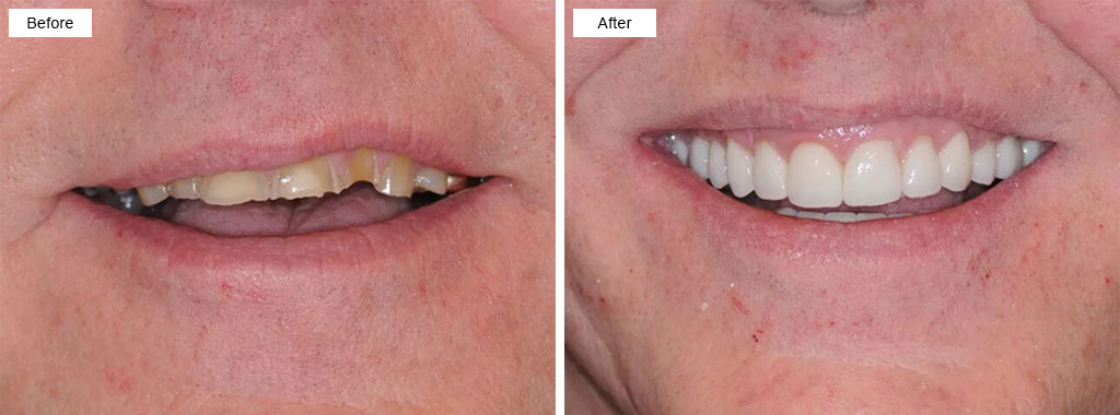 Full mouth rehabilitation with dental implants and ceramic crowns.