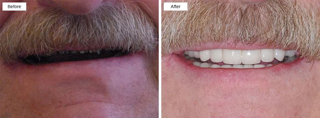 Limestone Coast Dental implants and ceramic crowns.