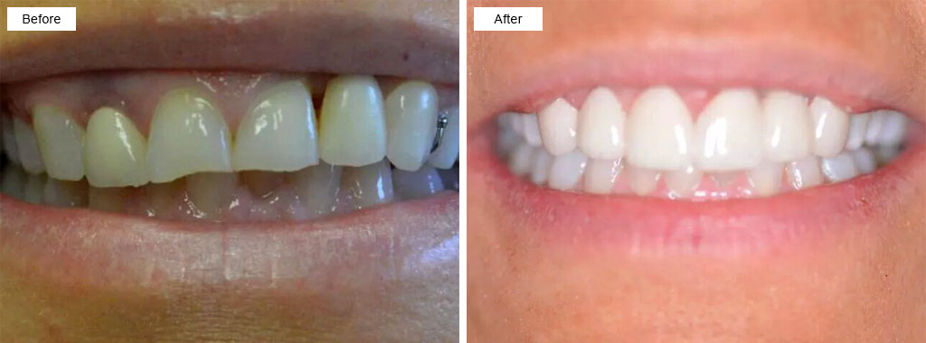 Limestone Coast Dental Crown and Bridges